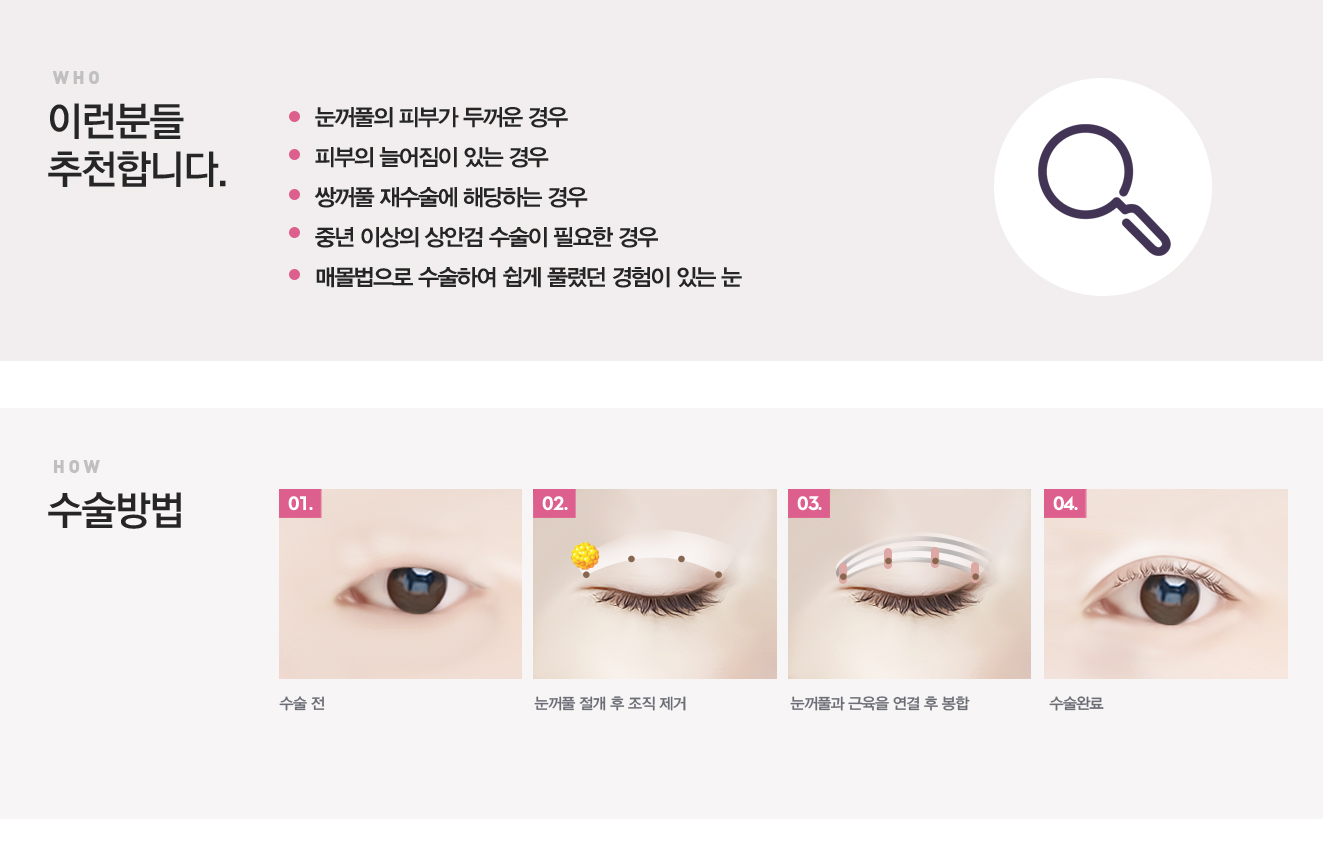 눈꺼풀이두툼한눈