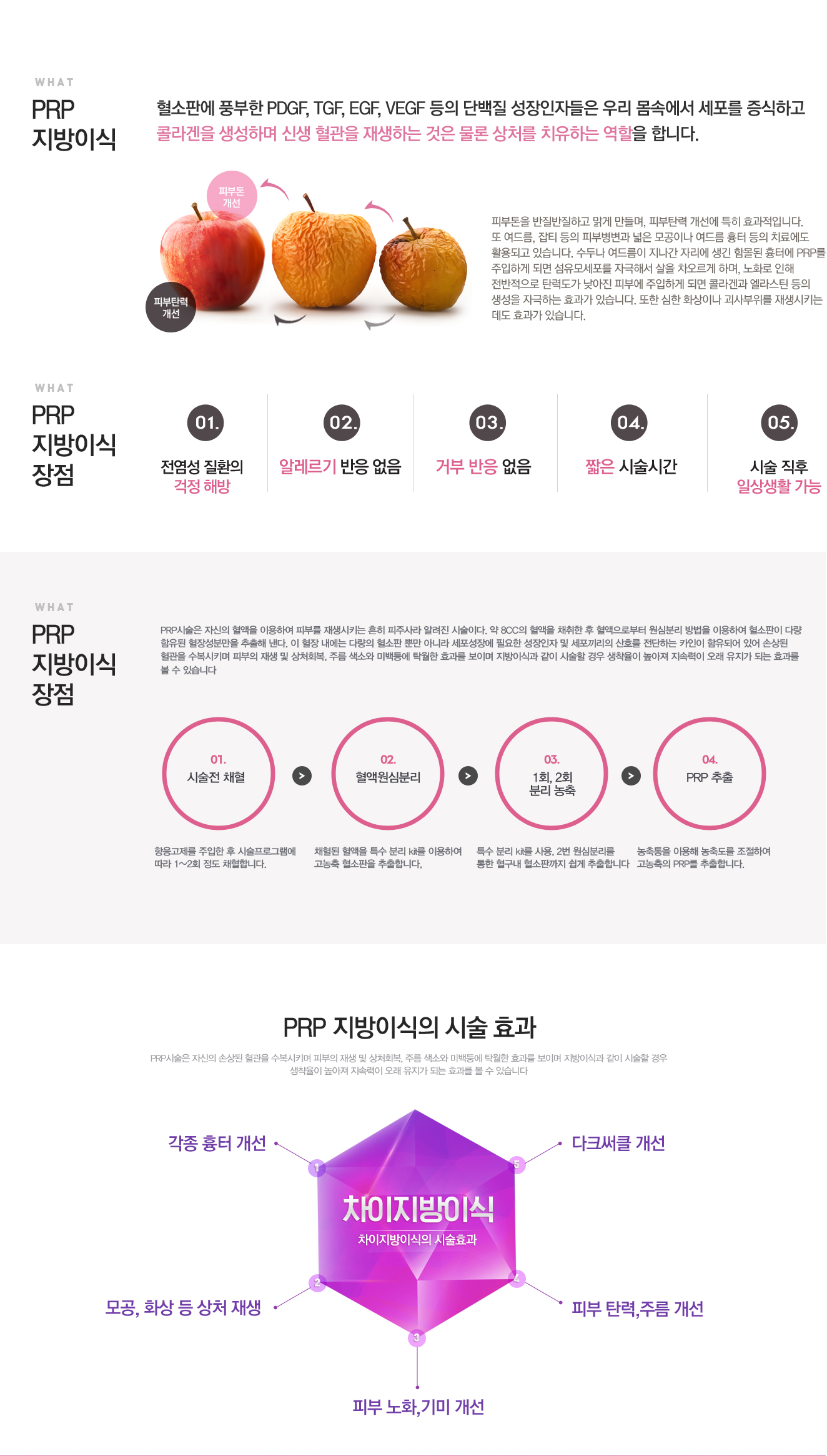 PRP지방이식